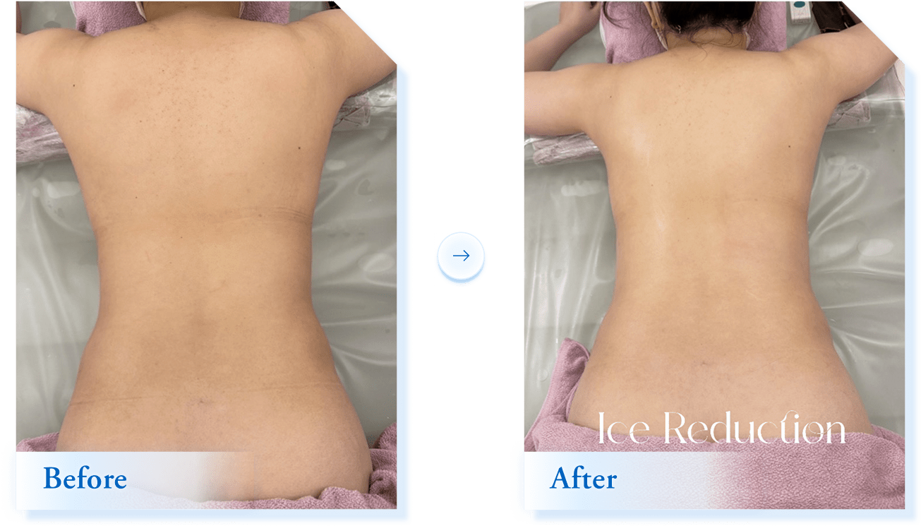 Ice Reduction beforeAfter