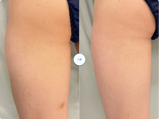 Ice Reduction beforeAfter