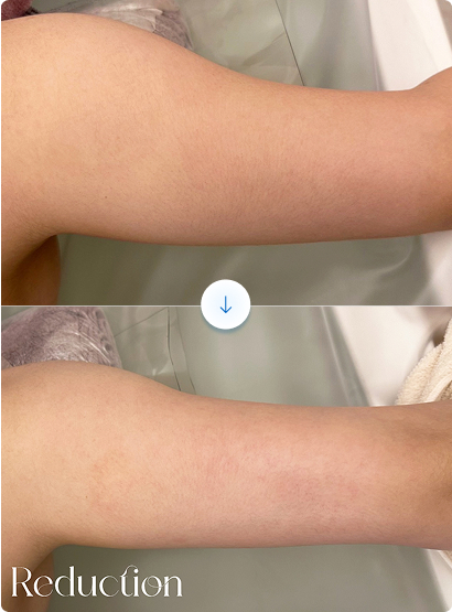 Ice Reduction beforeAfter